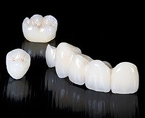 メタルボンド用の金属　歯科技工　12g 歯科技工所へインプラント（チタン・メタルボンド）を発注して高品質な